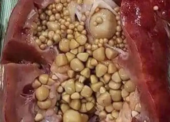 obat batu ginjal